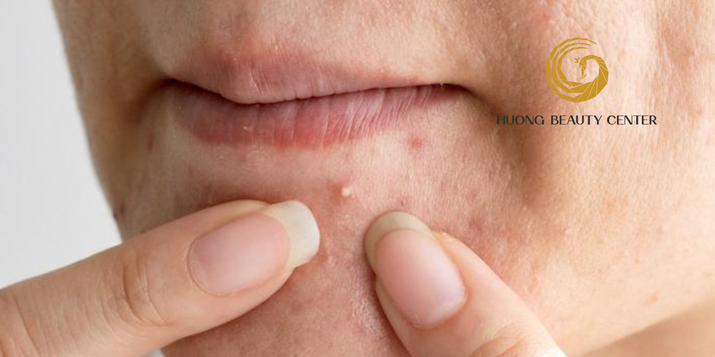 Mụn đầu trắng